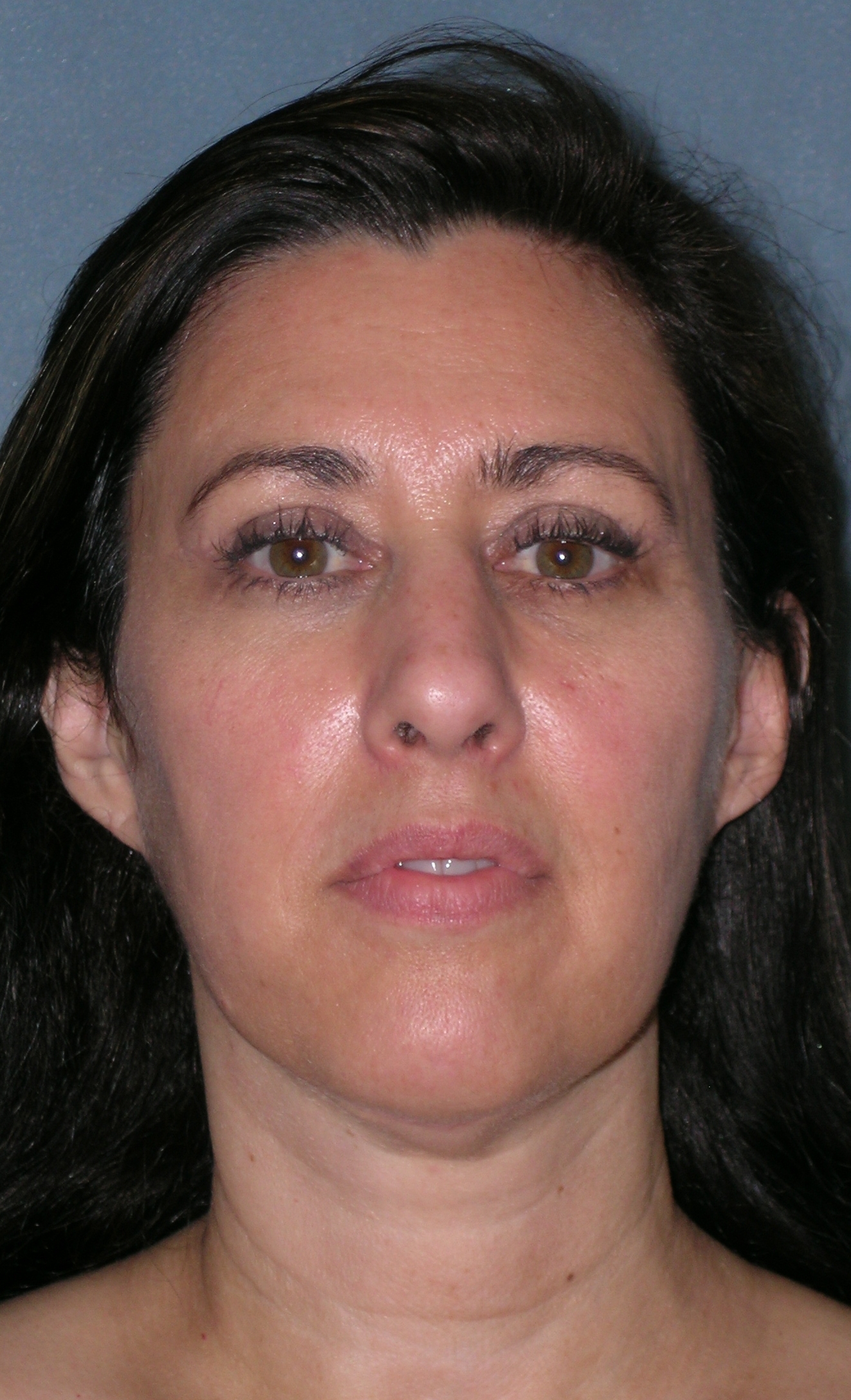 Facelift Before and After Photos