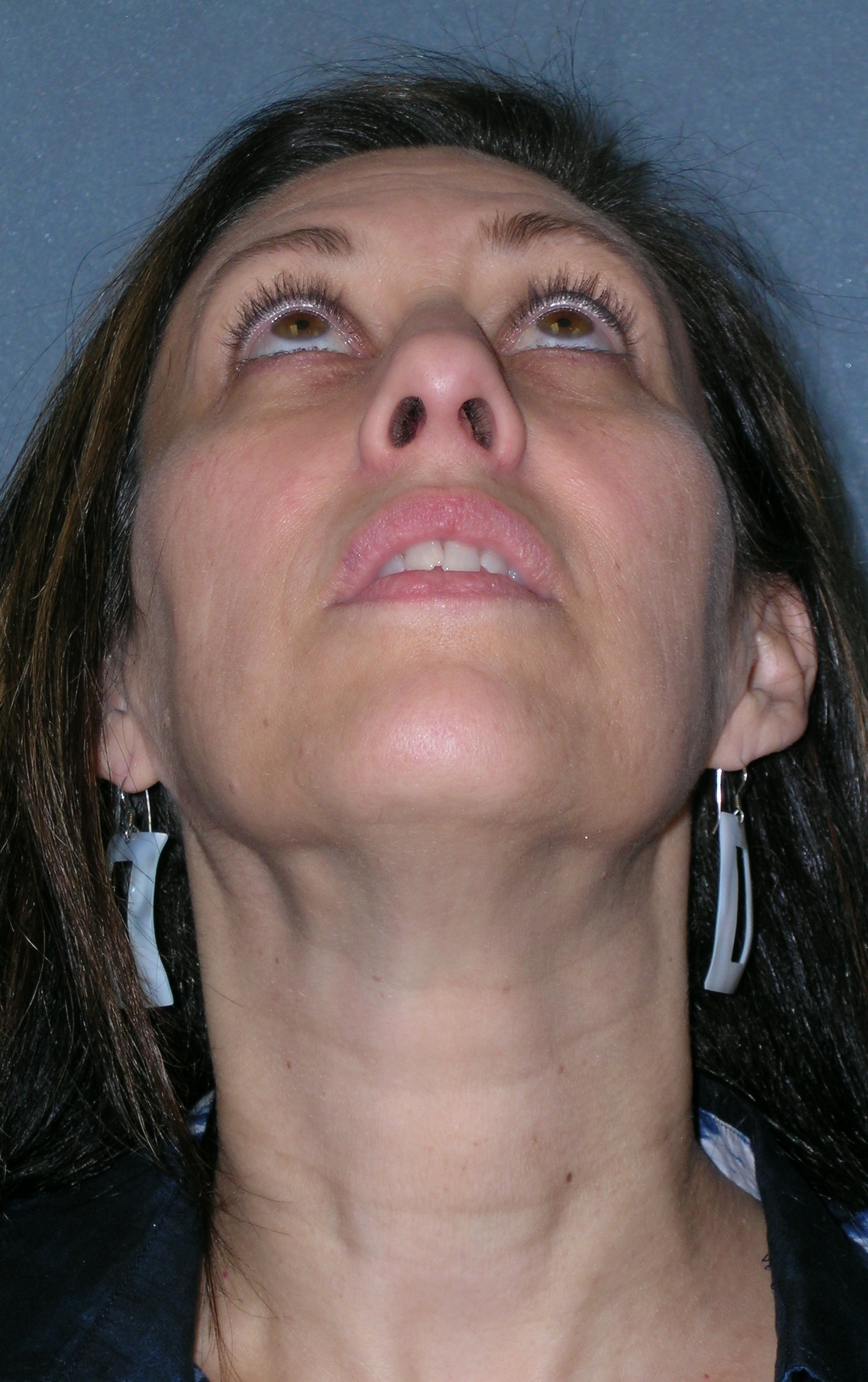 Woman’s lower face and neck before facelift