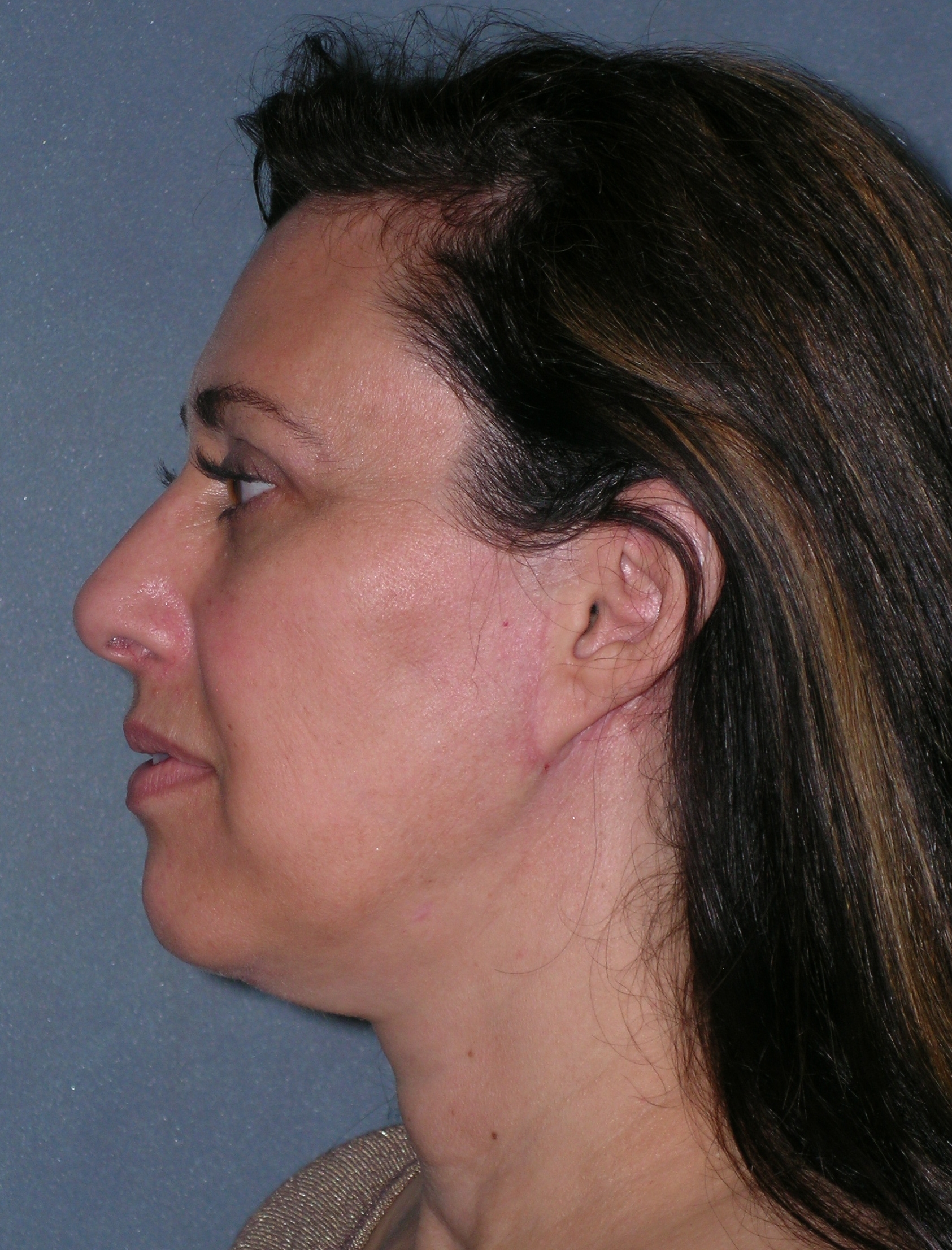 Facelift Before and After Photos