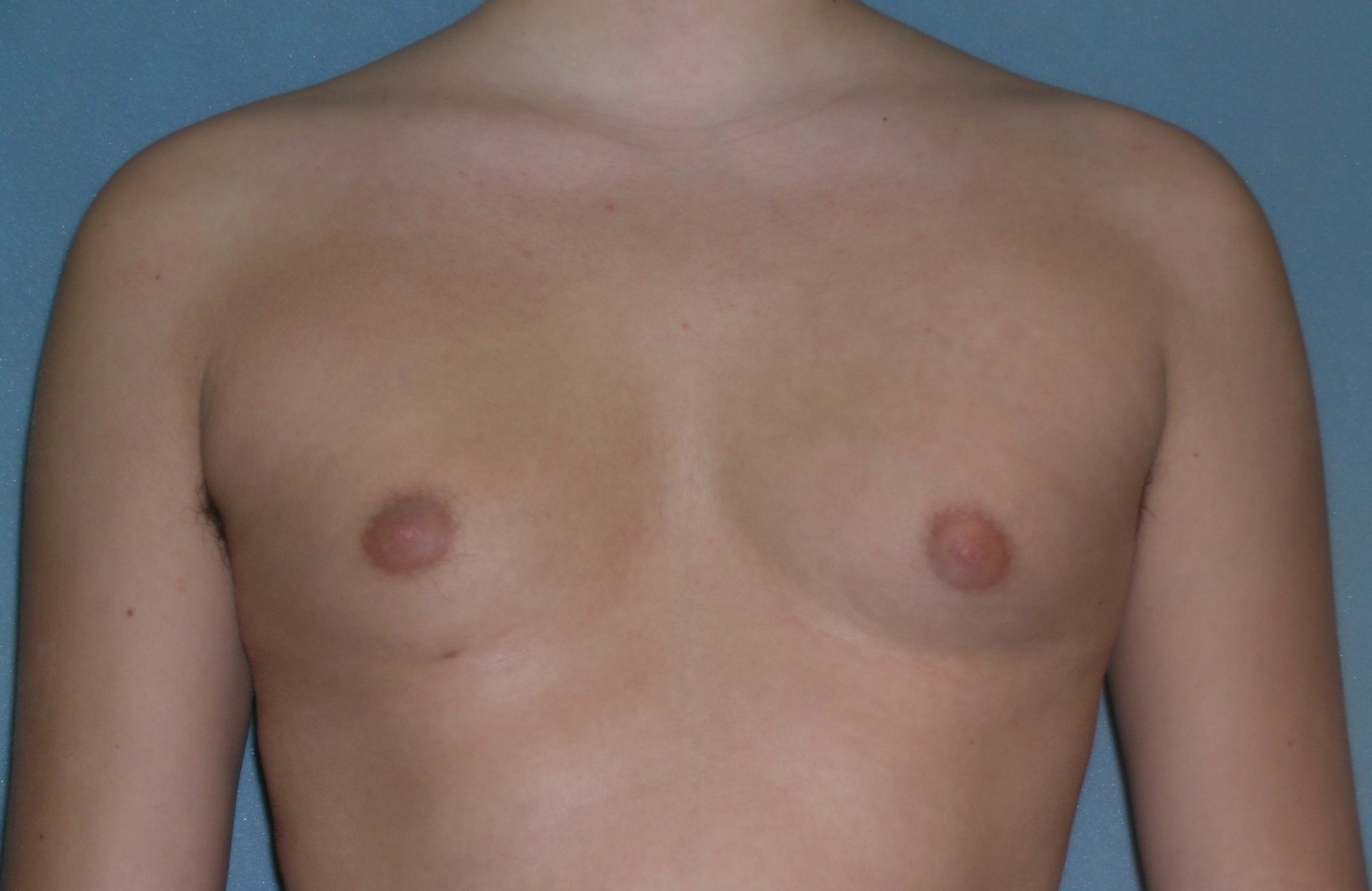 Male Breast Reduction Before and After Photos | Dr. Balakhani