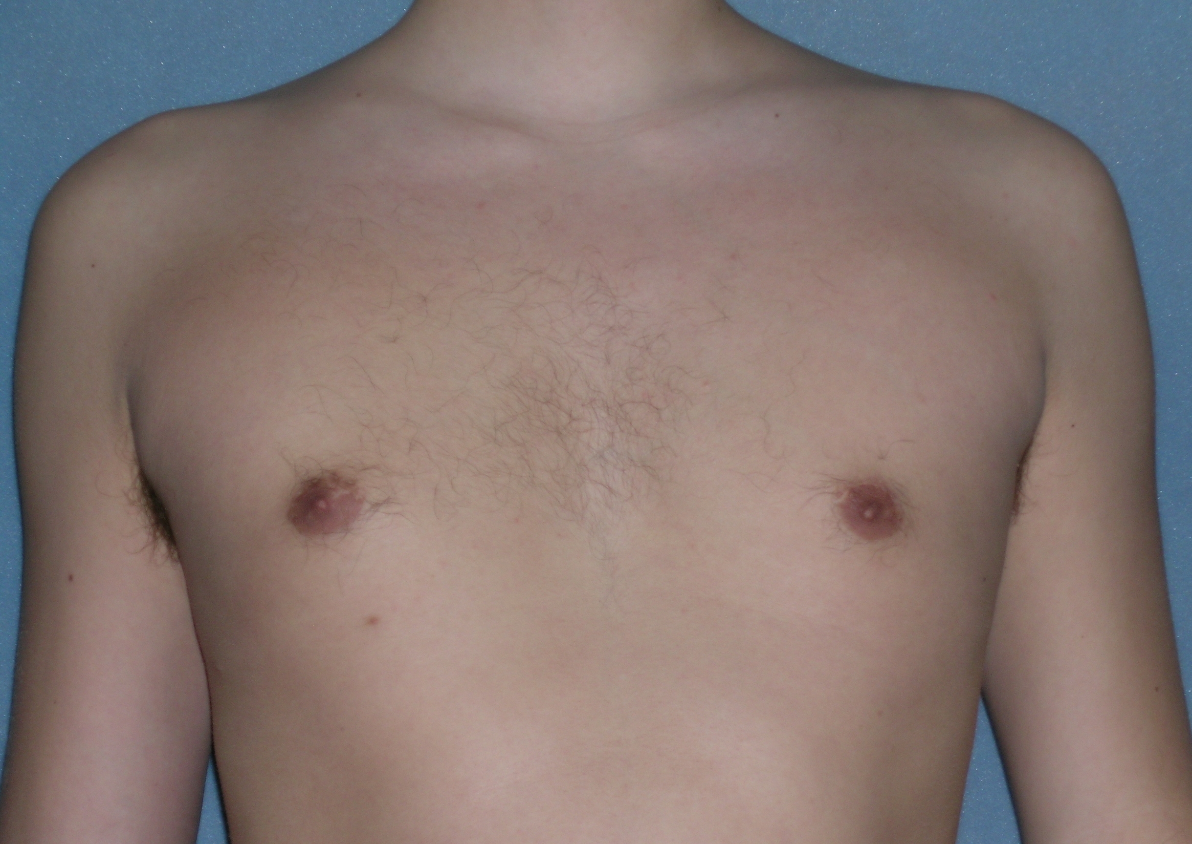 Male Breast Reduction Before and After Photos | Dr. Balakhani