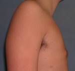 Male Breast Reduction