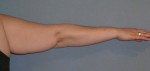 Arm Lift