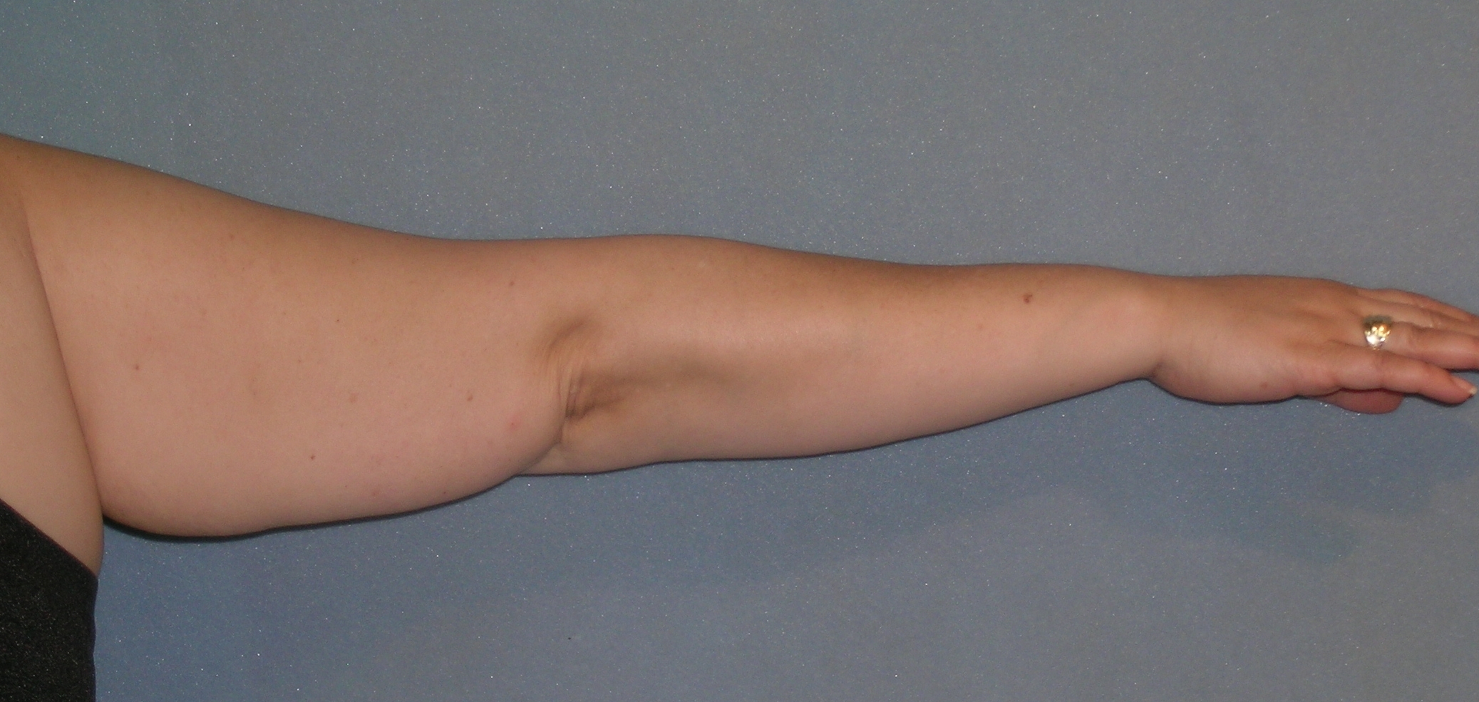 Arm Lift Before and After Photos | Dr. Balakhani