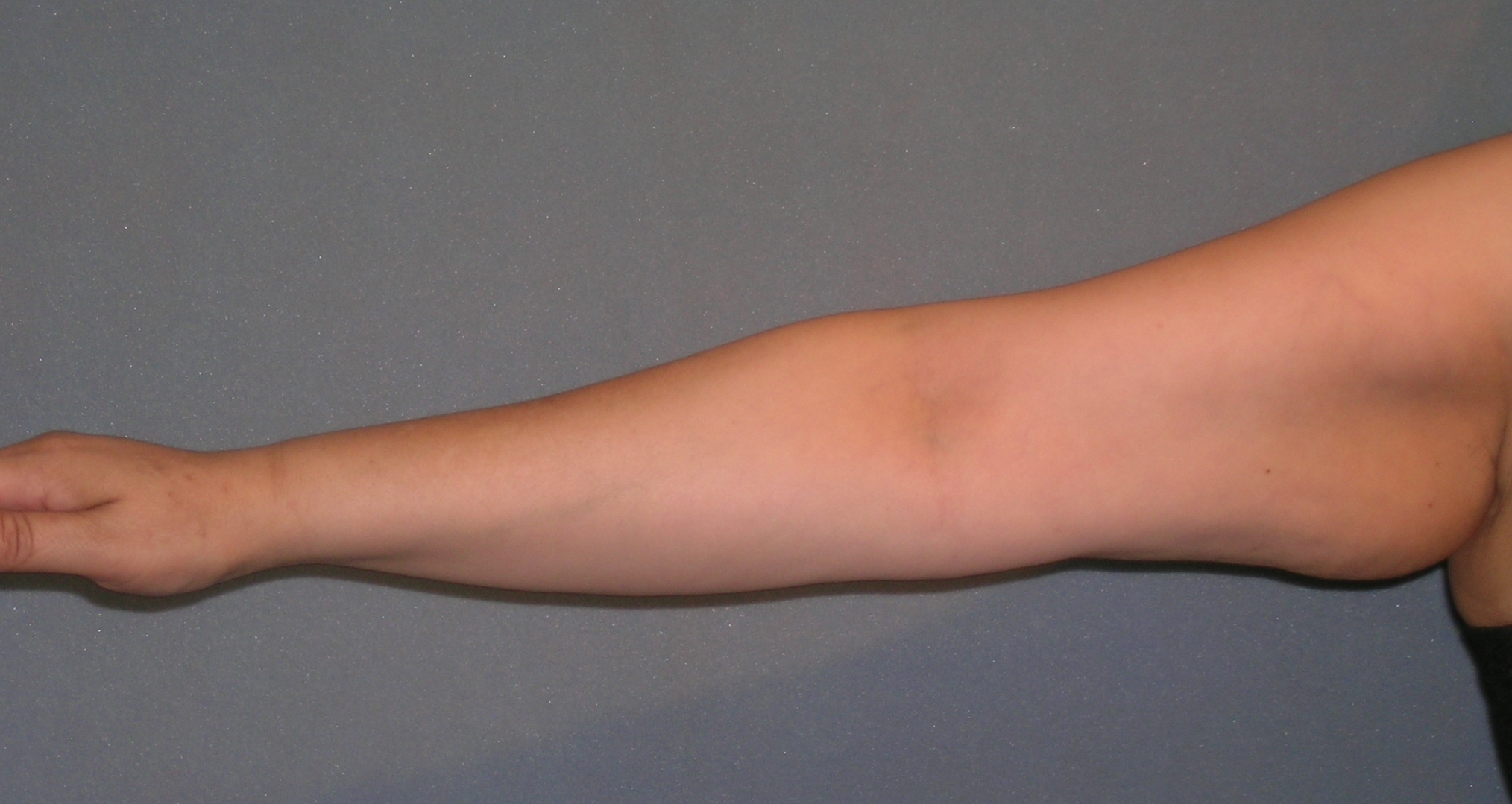 Arm Lift Before and After Photos | Dr. Balakhani