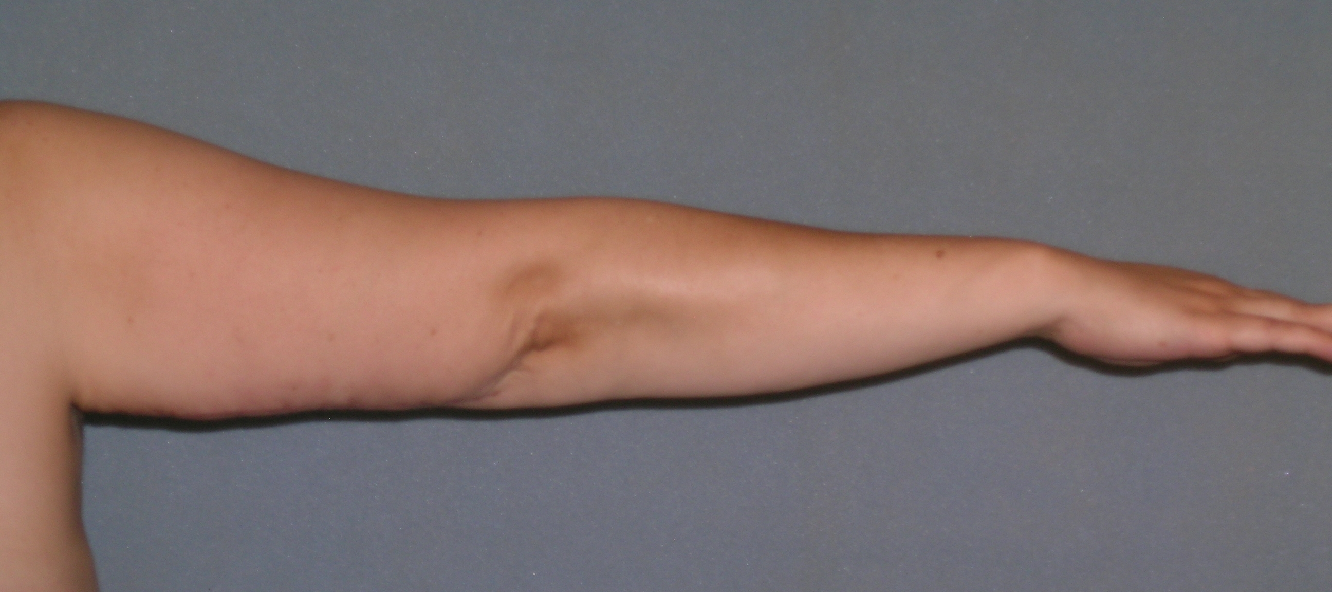 Arm Lift Before and After Photos | Dr. Balakhani