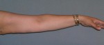Arm Lift