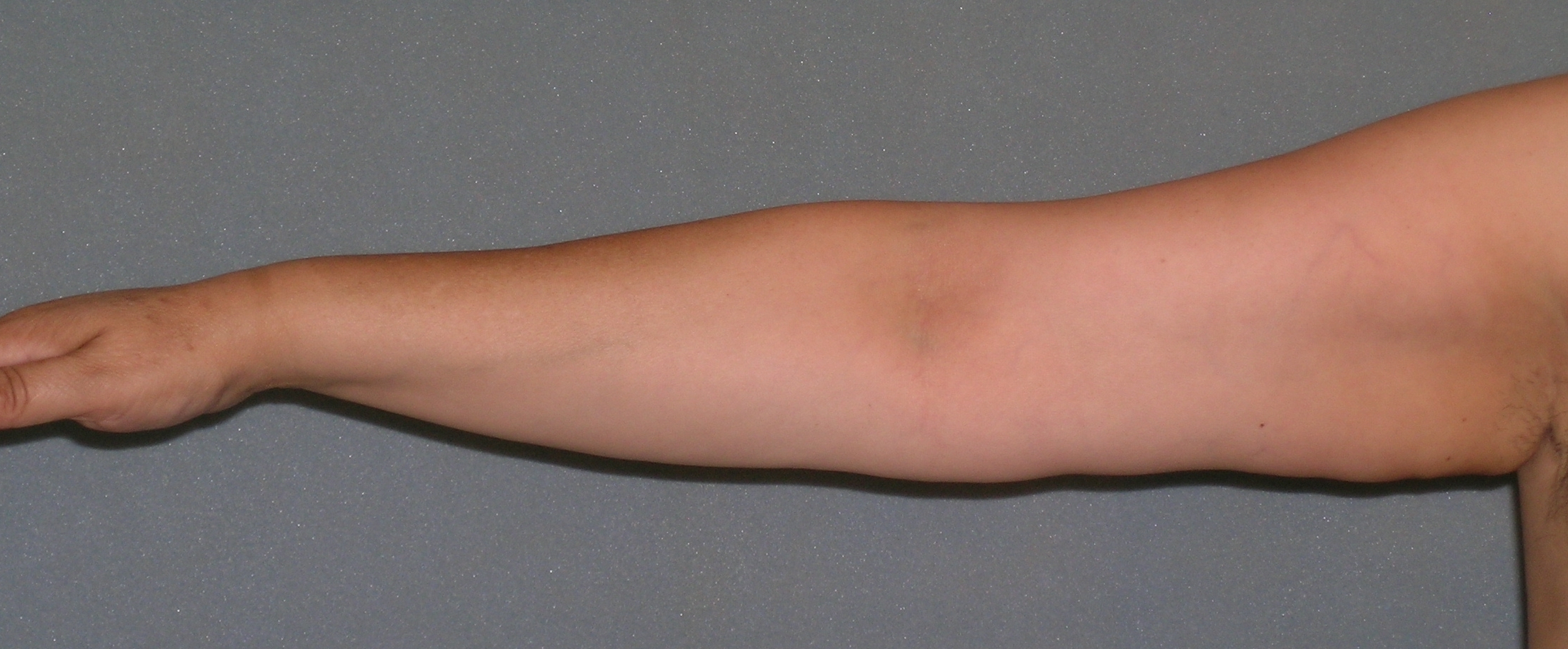 Arm Lift Before and After Photos | Dr. Balakhani