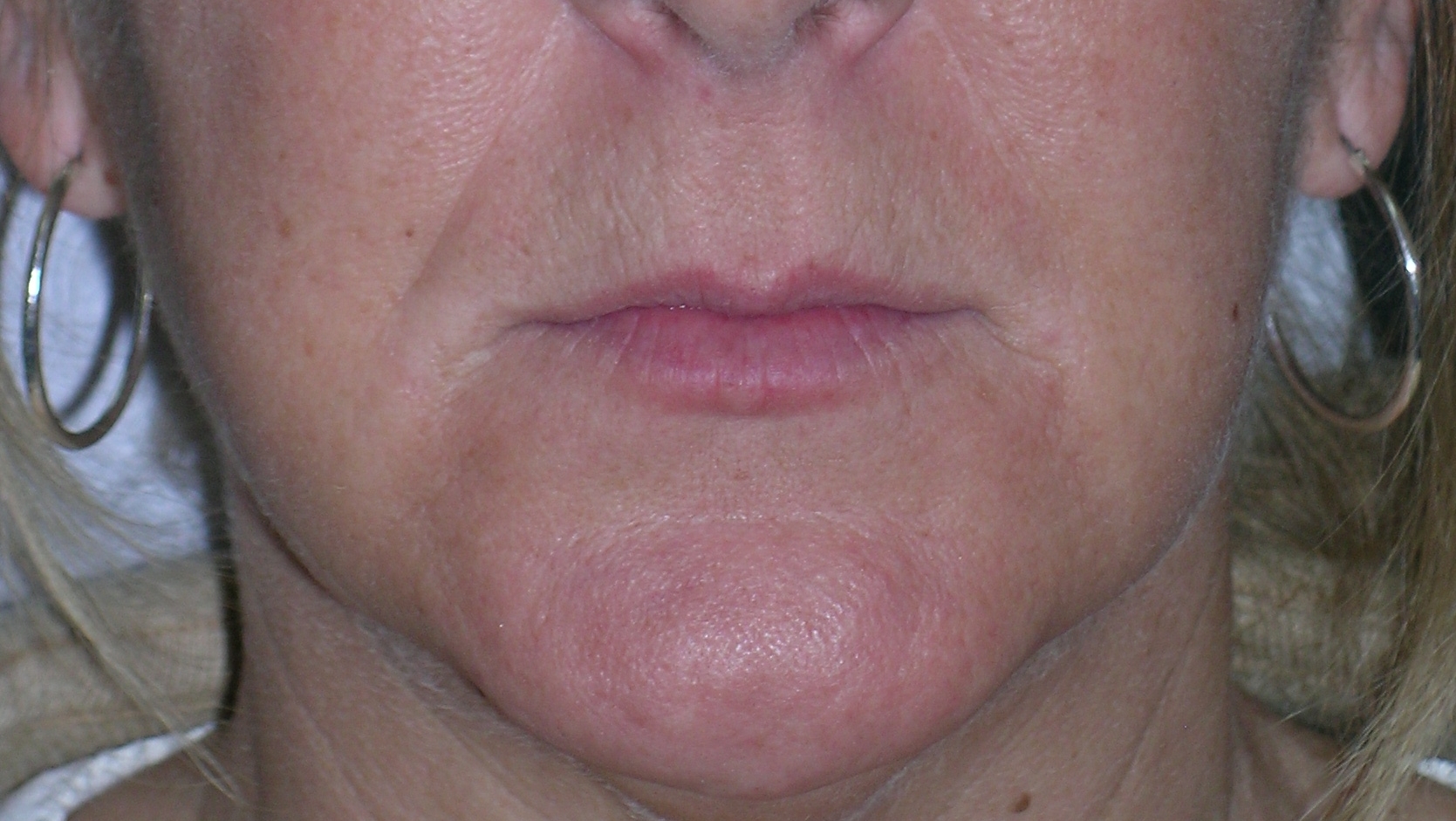 Dermal Fillers Before and After Photos