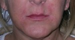 Dermal Fillers