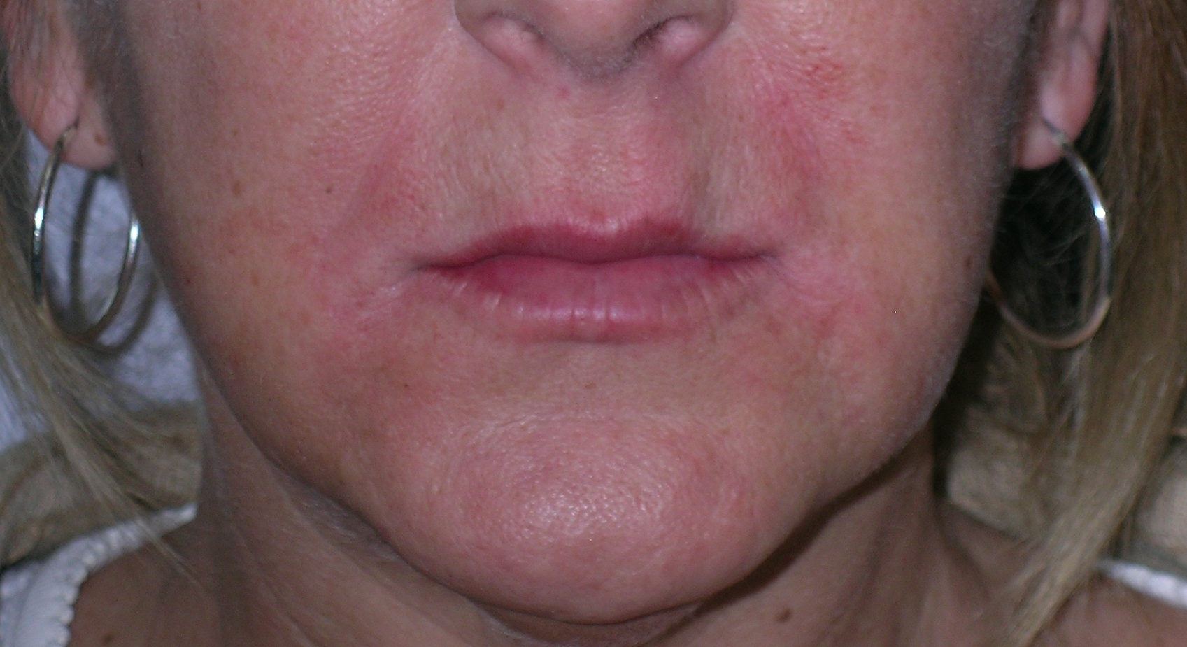 Dermal Fillers Before and After Photos