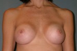 Augmentation Mammoplasty