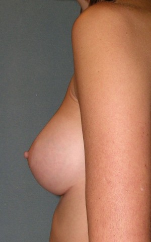Augmentation Mammoplasty Case 3990 After Photo Augmentation Mammoplasty