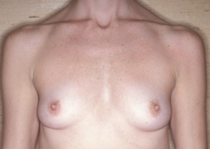 Augmentation Mammoplasty Case 3990 Before Photo Augmentation Mammoplasty