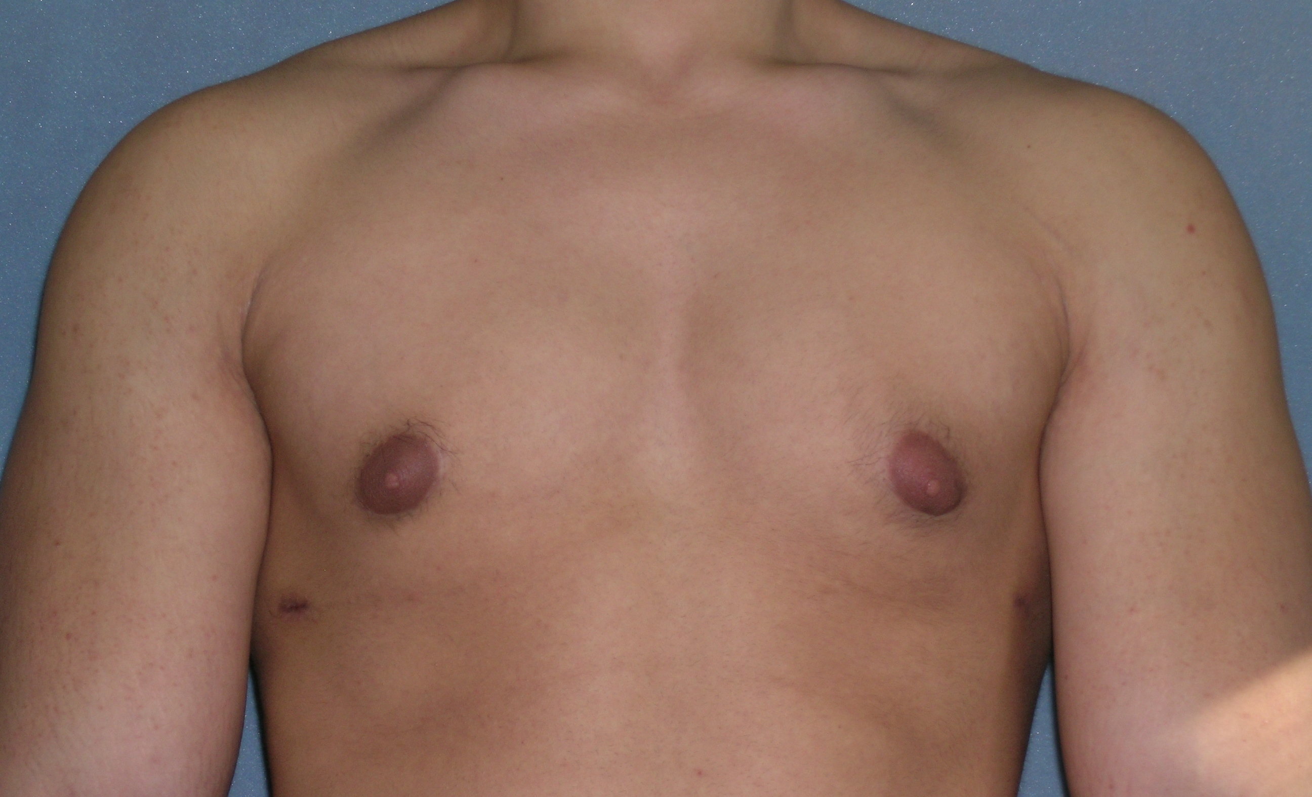 Male Breast Reduction Before and After Photos | Dr. Balakhani