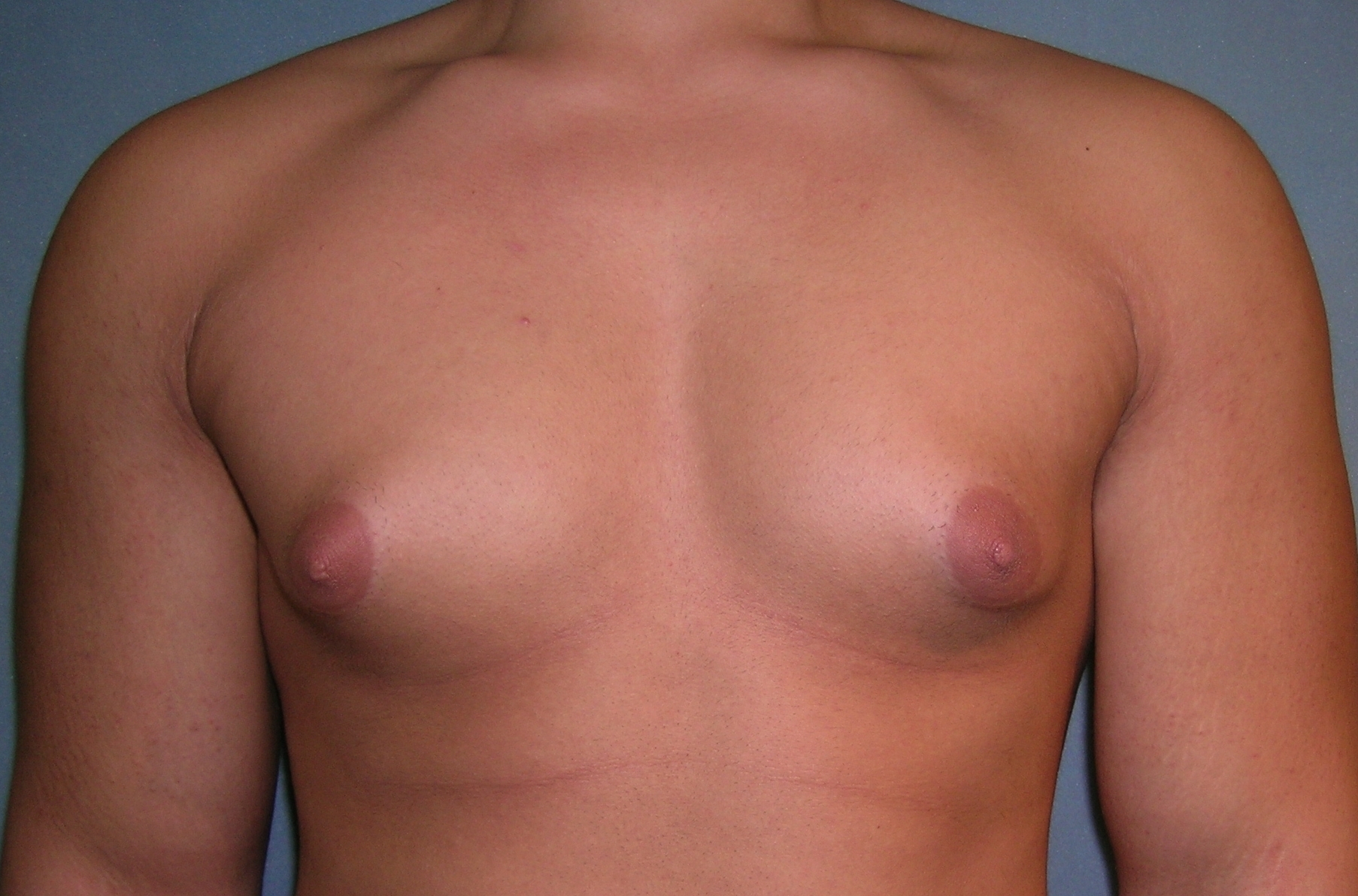 Male Breast Reduction Before and After Photos | Dr. Balakhani