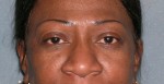 Micropigmentation