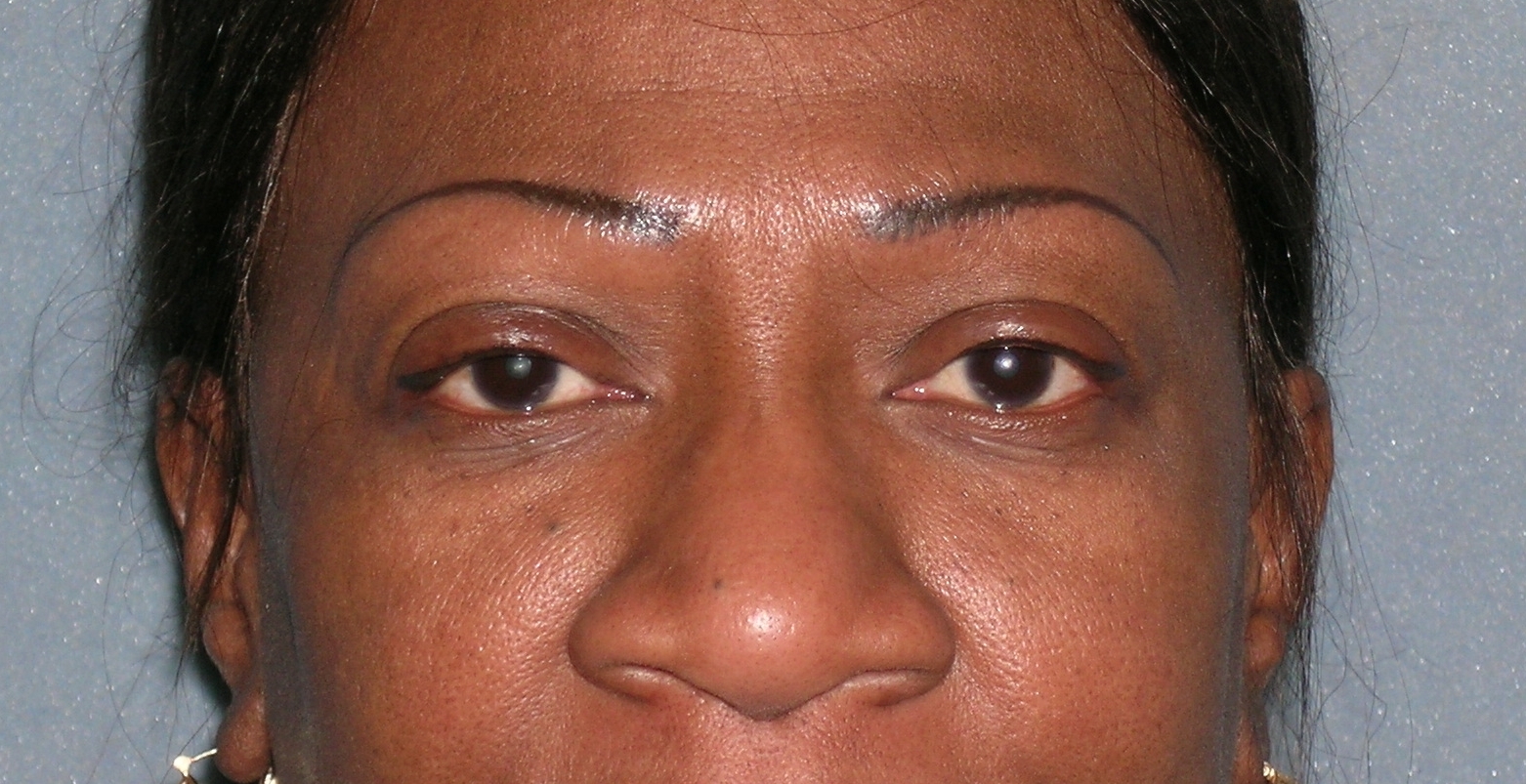 Micropigmentation Before and After Photos | Dr. Balakhani