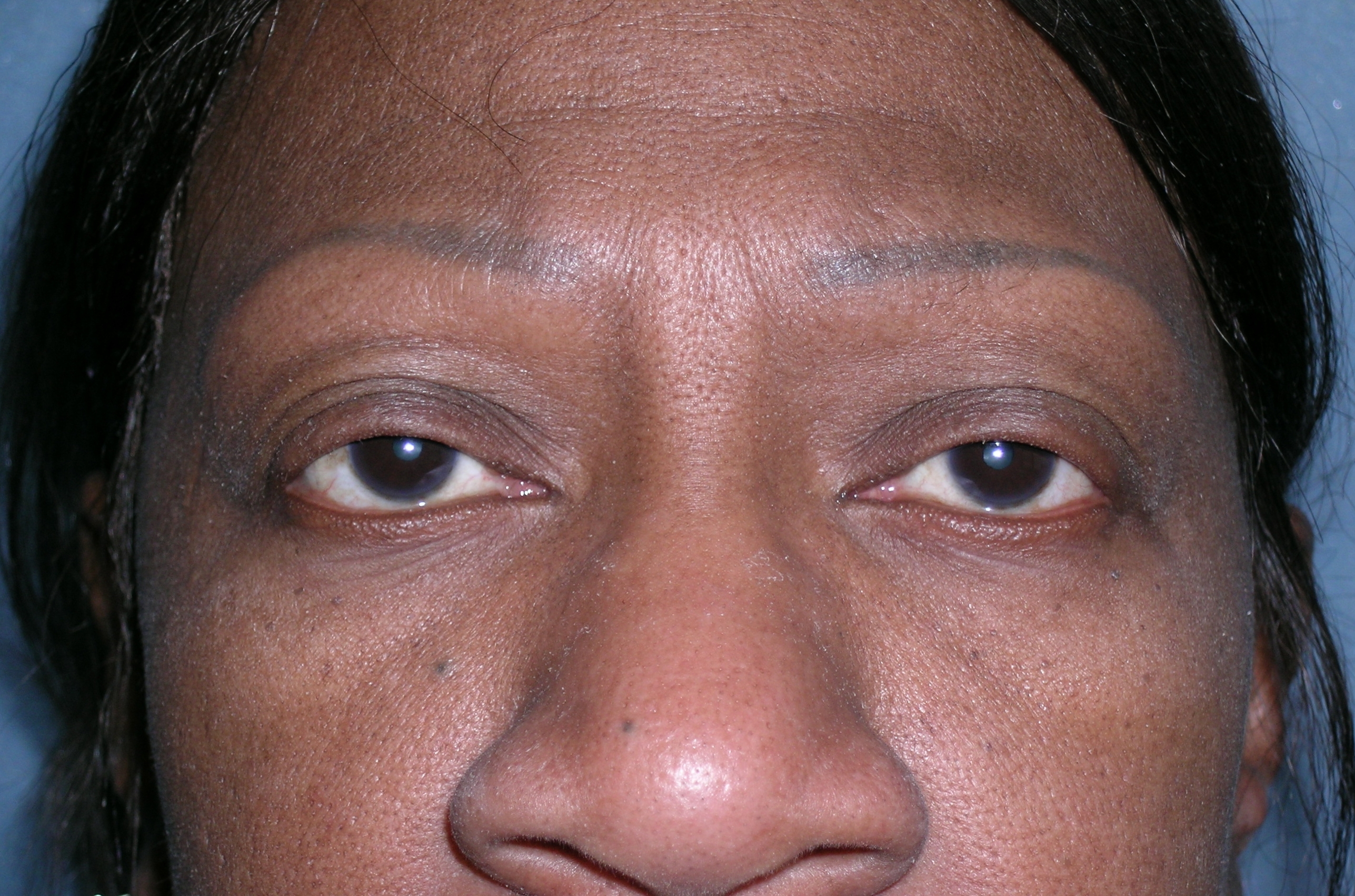 Micropigmentation Before and After Photos | Dr. Balakhani