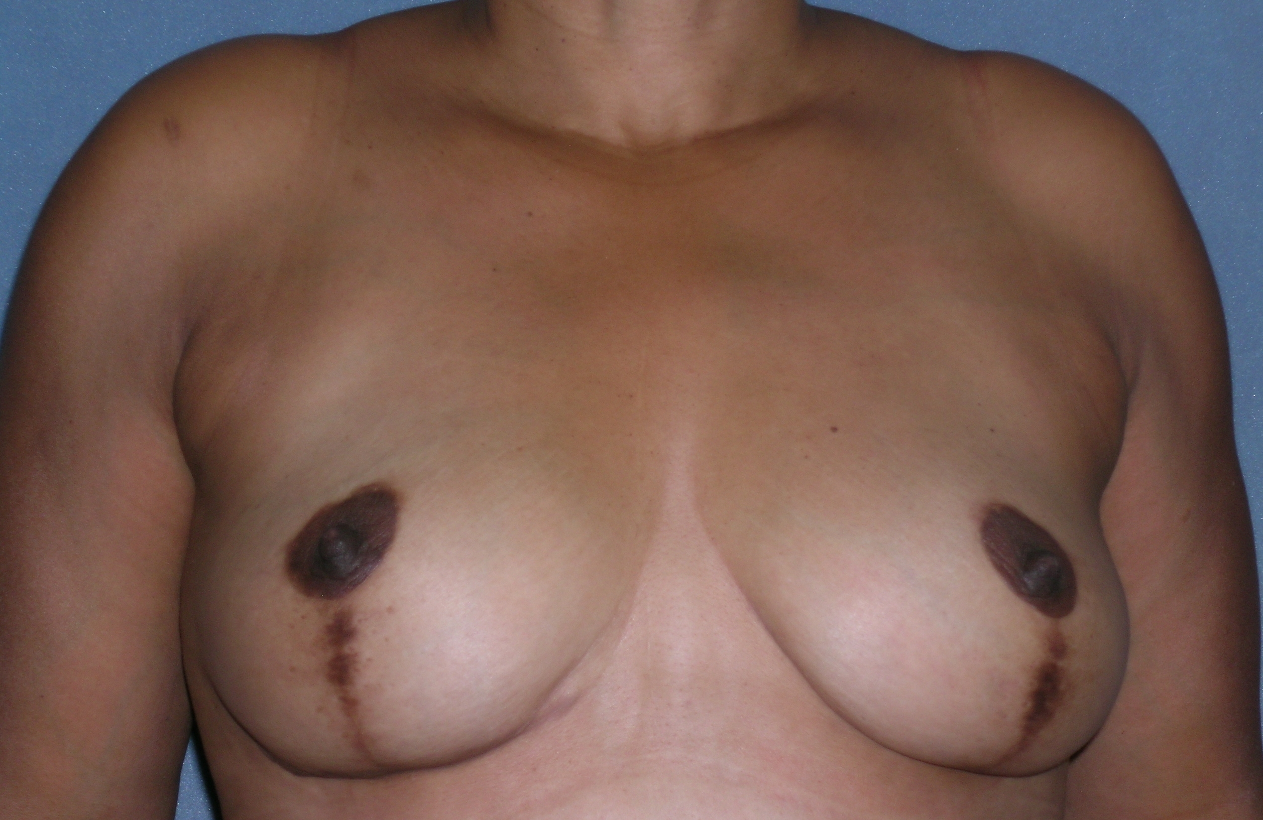 Mastopexy Augmentation Before and After Photos