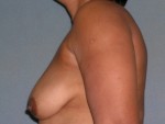 Mastopexy Augmentation