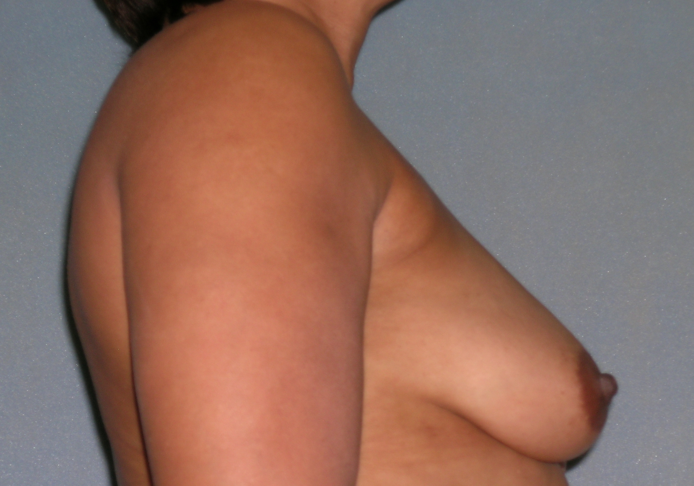 Mastopexy Augmentation Before and After Photos