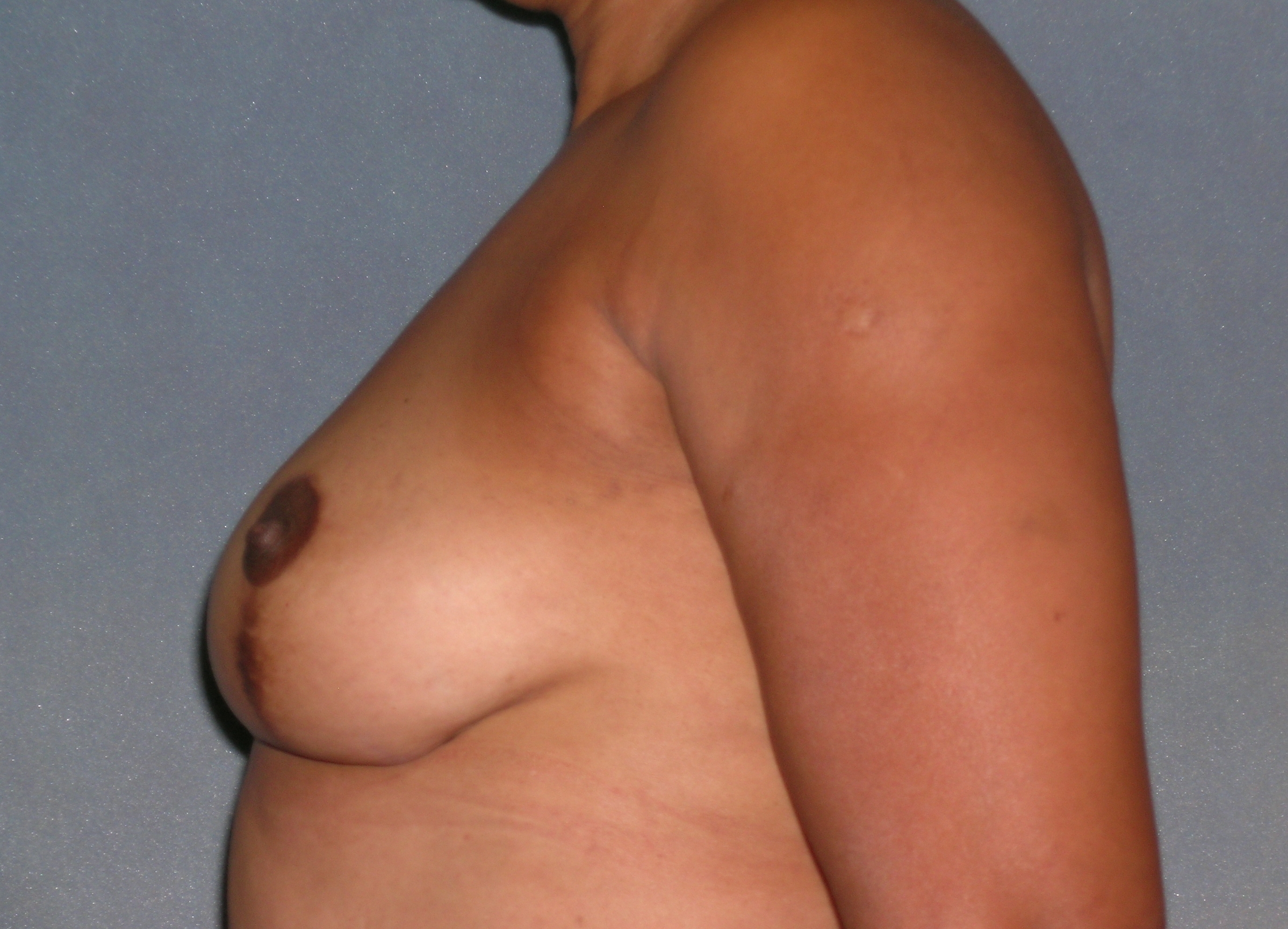 Mastopexy Augmentation Before and After Photos