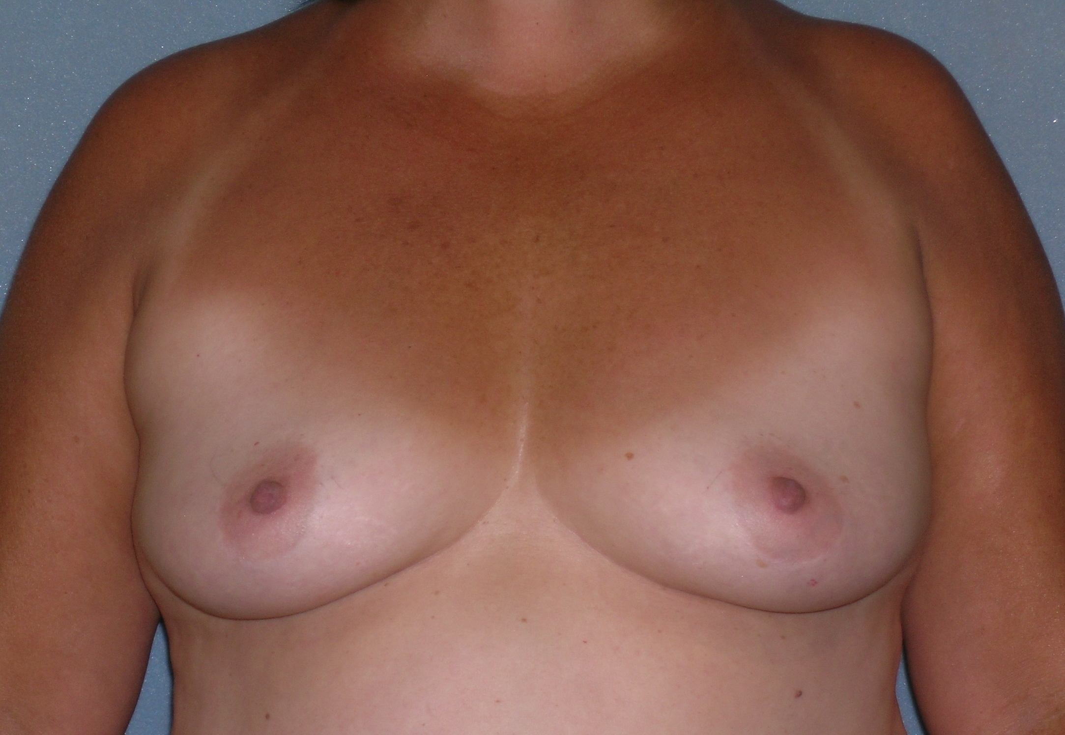 Augmentation Mammoplasty Before and After Photos