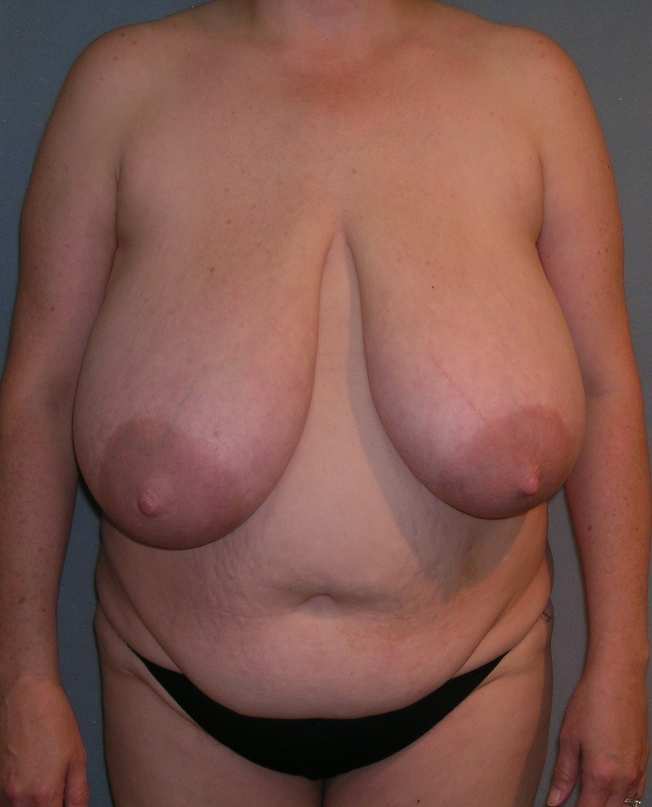 Breast and Abdomen Before and After Photos