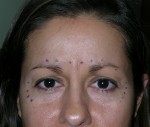 Botulinum Toxin