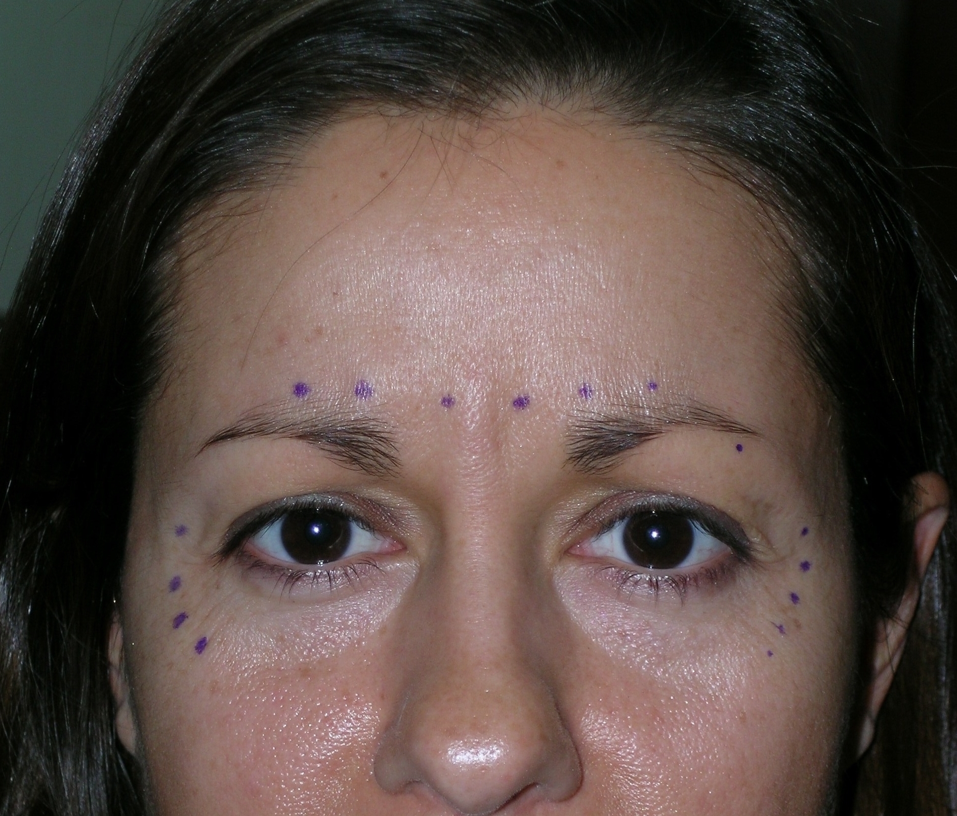 Botulinum Toxin Before and After Photos