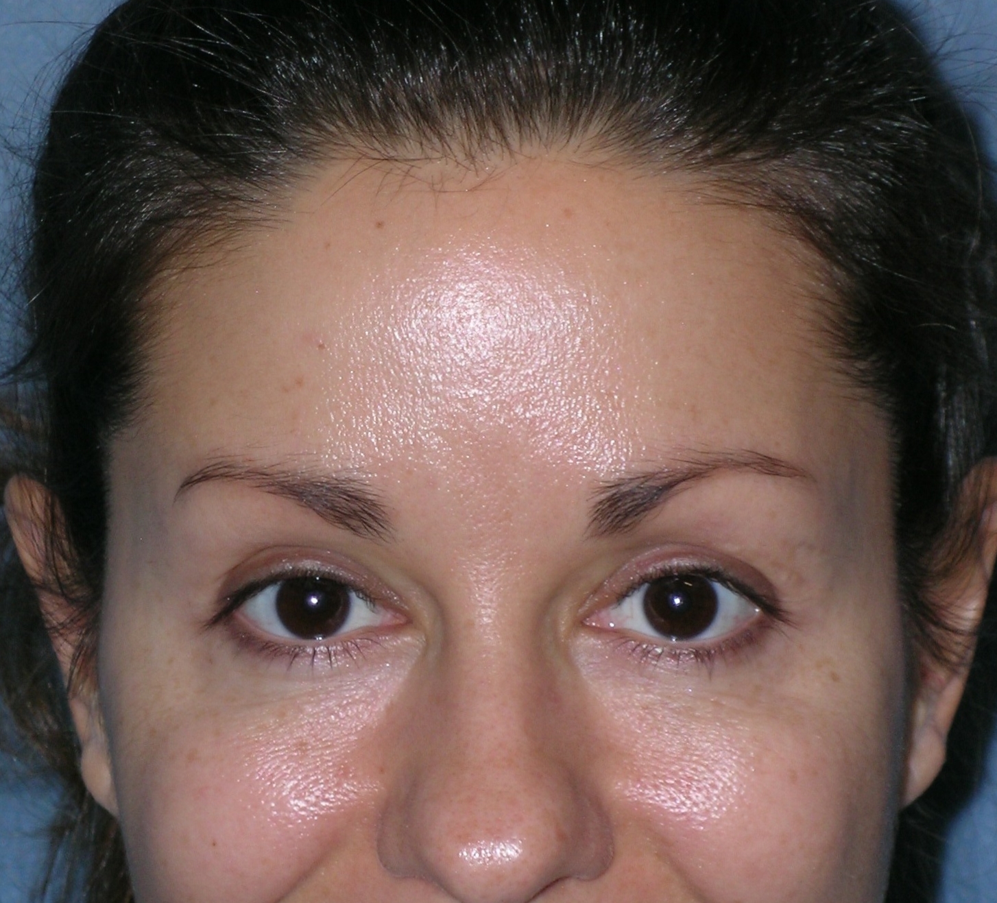 Botulinum Toxin Before and After Photos