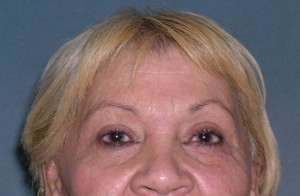 Blepharoplasty Case 4076 After Photo Blepharoplasty