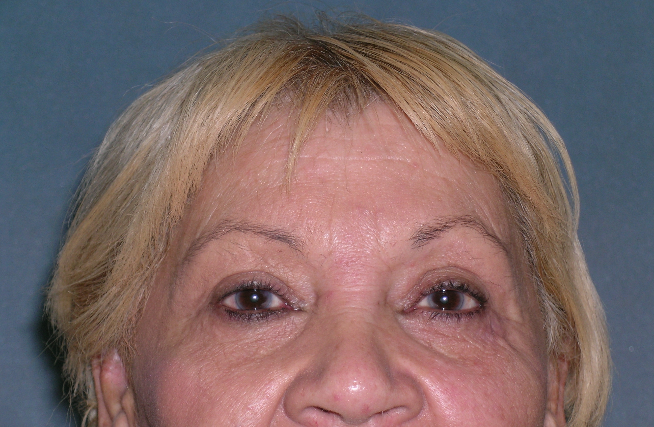 Blepharoplasty Before and After Photos