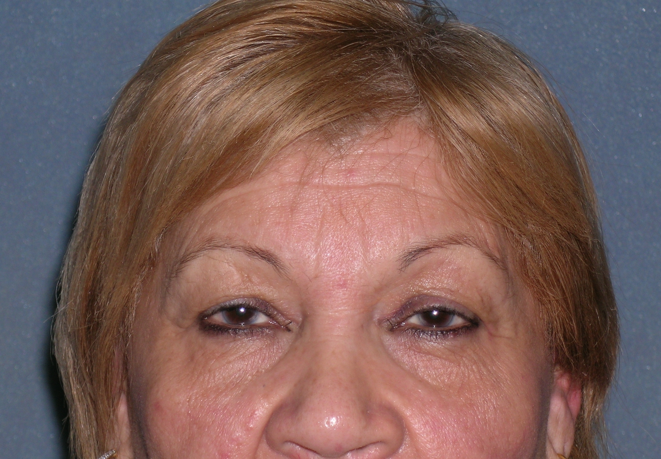 Blepharoplasty Before and After Photos