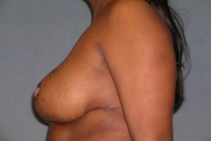 Breast Reduction Case 4090 After Photo Breast Reduction