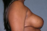 Breast Reduction