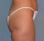 Body Liposculpture