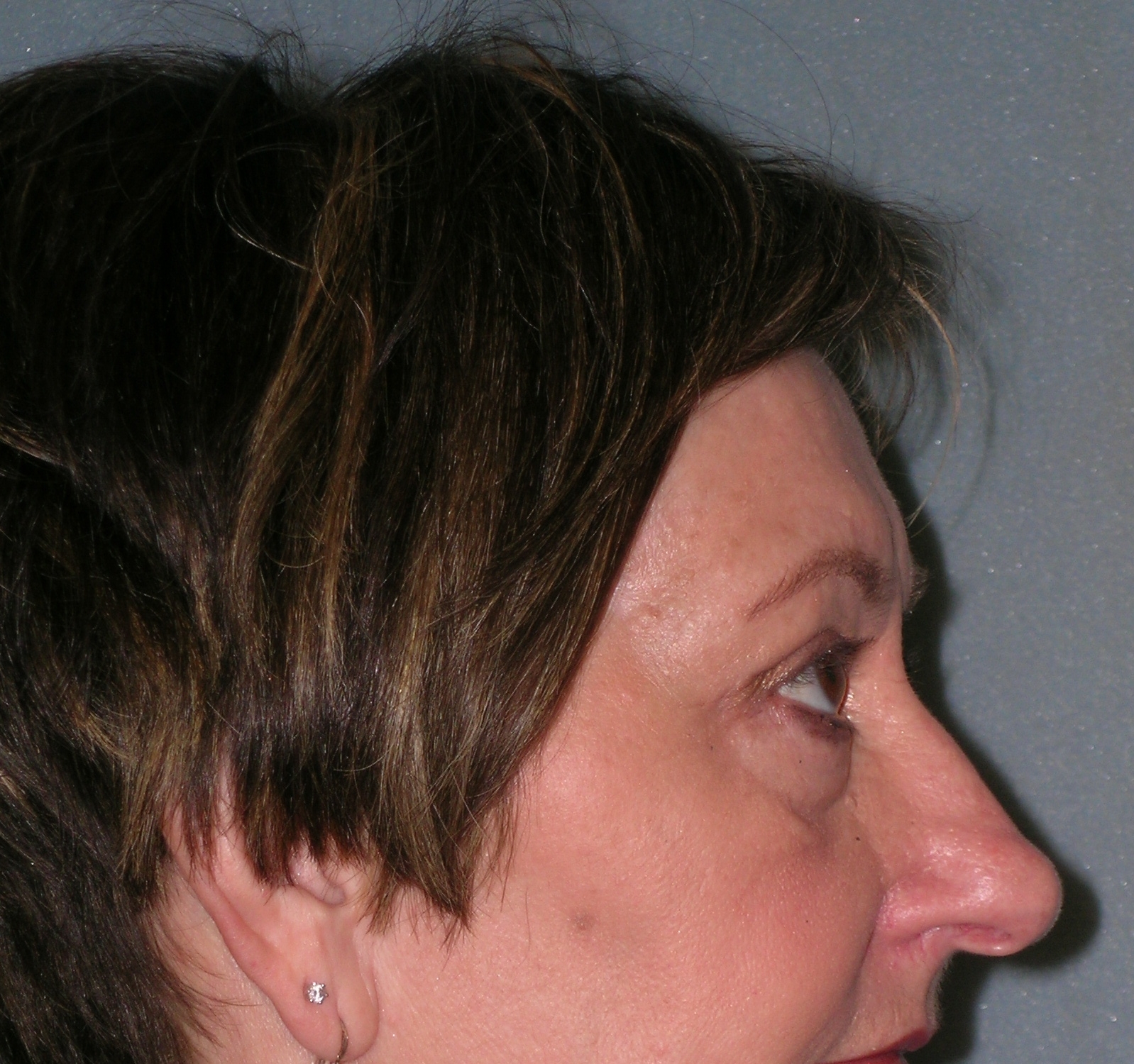 Endoscopic Forehead Lift Before and After Photos