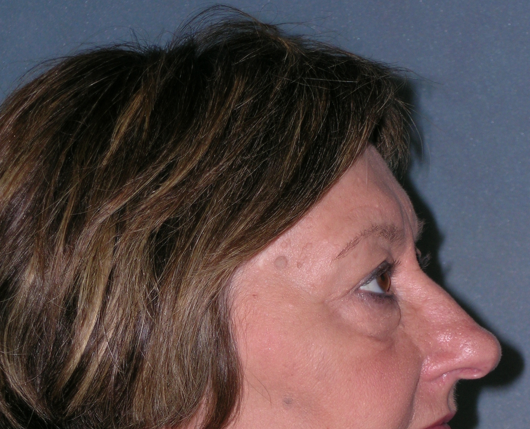 Endoscopic Forehead Lift Before and After Photos