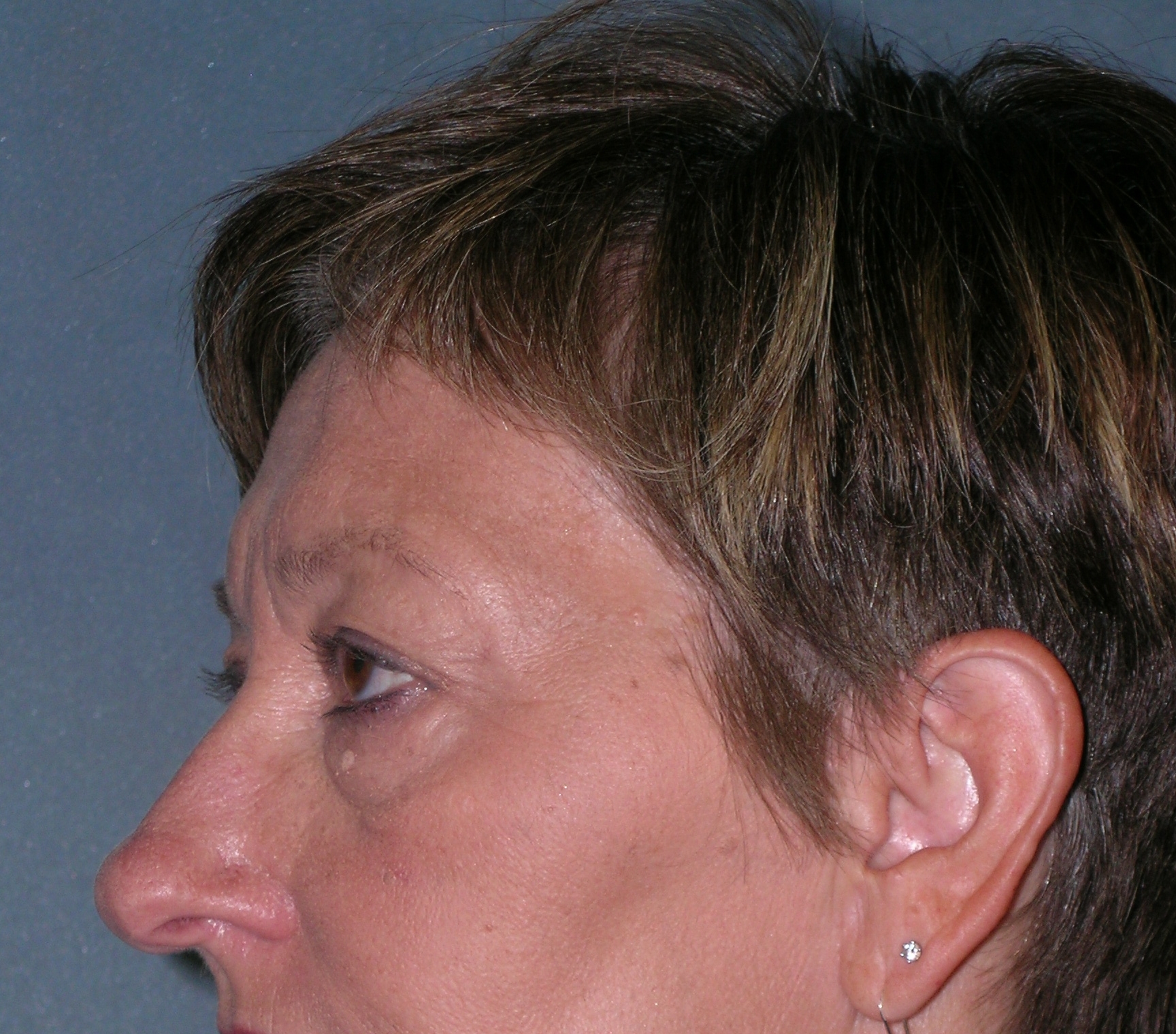 Endoscopic Forehead Lift Before and After Photos