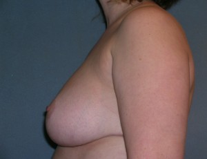 Breast Reduction Case 4111 After Photo Breast Reduction