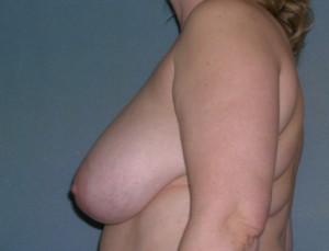 Breast Reduction Case 4111 Before Photo Breast Reduction