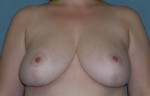 Breast Reconstruction Delaware