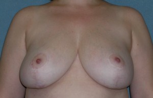 Breast Reduction Case 4111 After Photo Breast Reduction