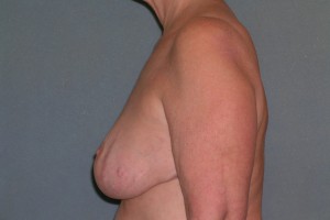 Breast Reconstruction Case 4118 After Photo Breast Reconstruction