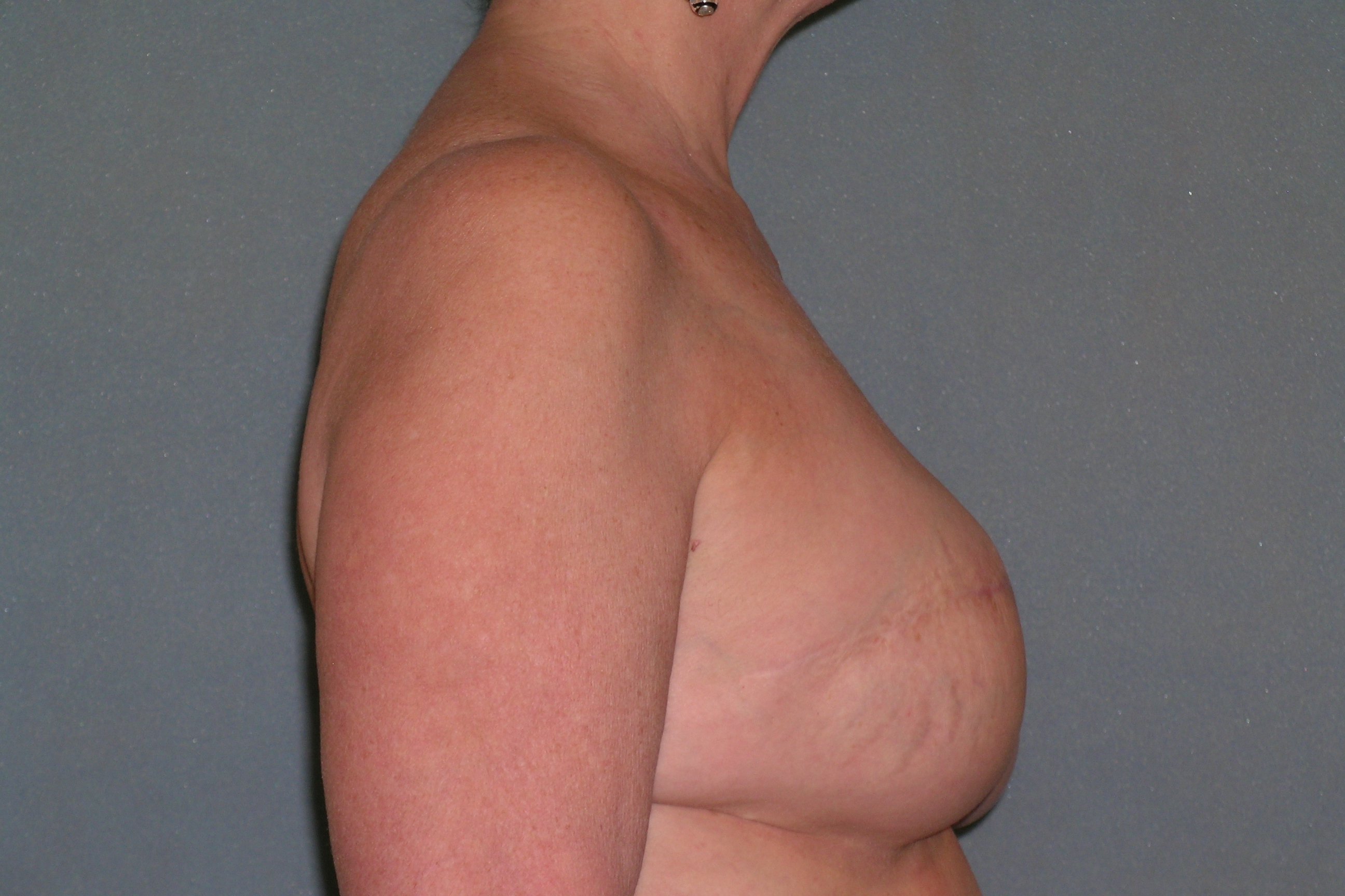 Breast Reconstruction Before and After Photos