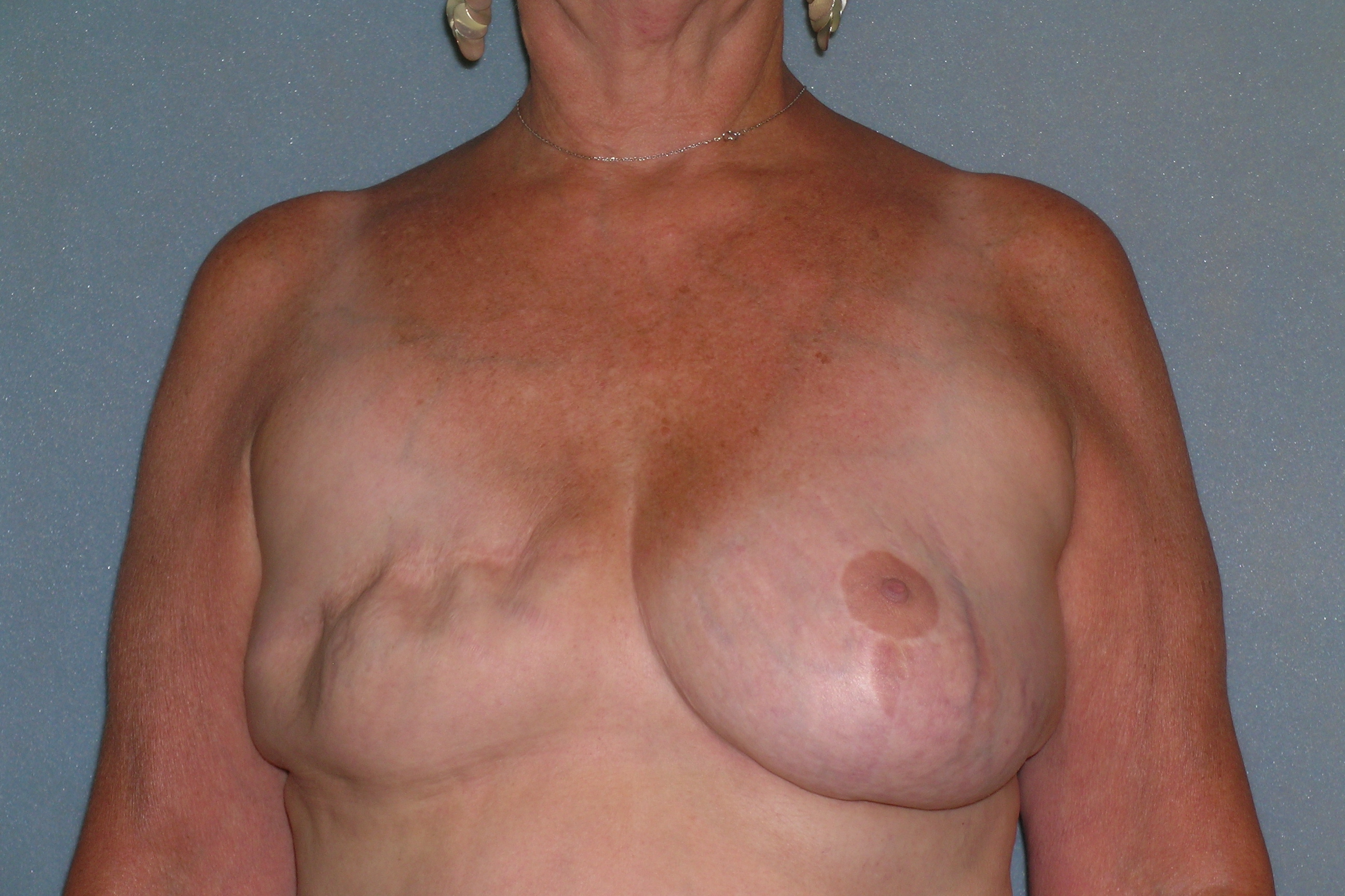 Breast Reconstruction Before and After Photos