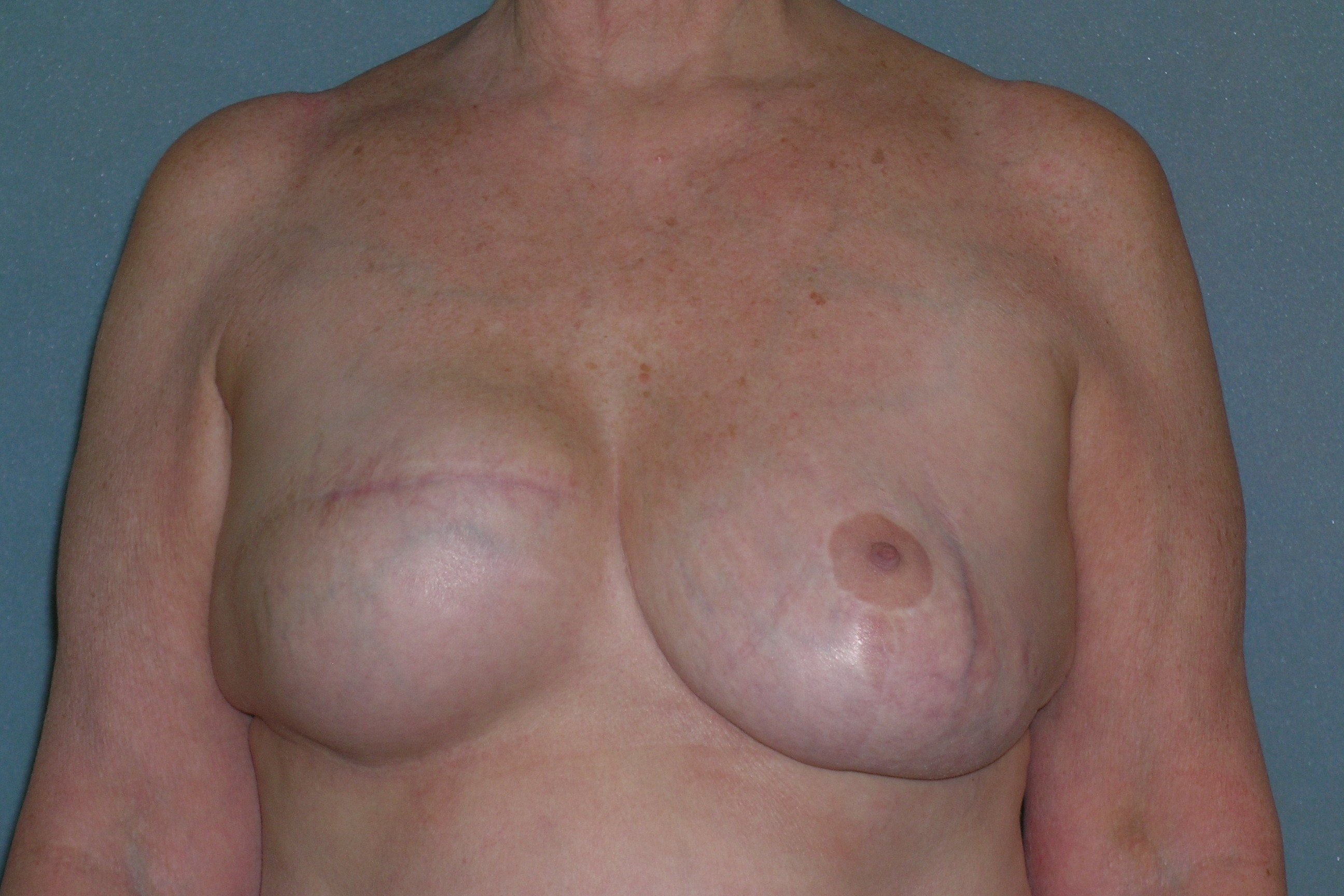 Breast Reconstruction Before and After Photos