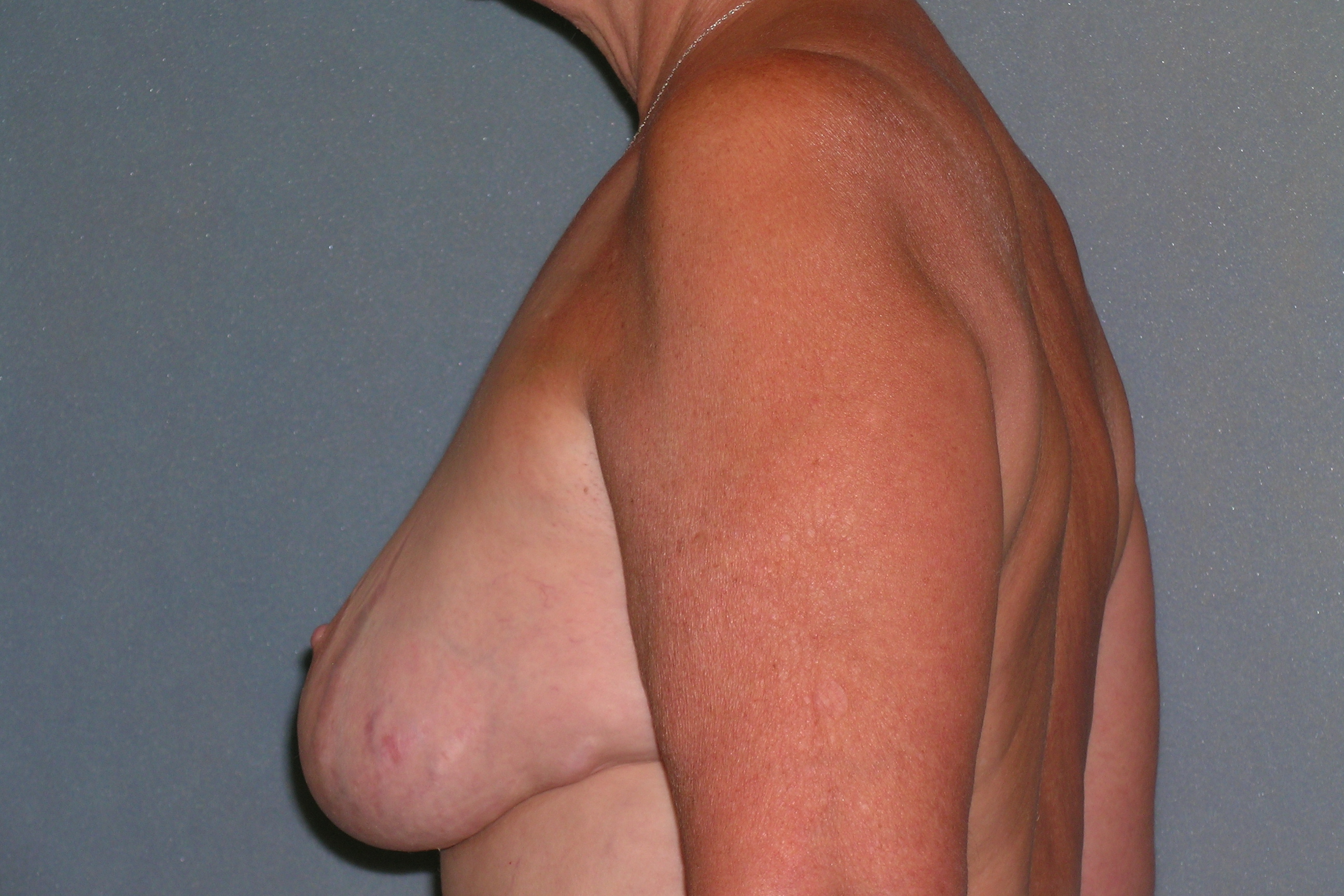 Breast Reconstruction Before and After Photos